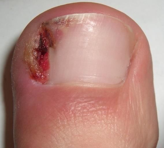 Hydrogen Peroxide For Foot and Toenail Fungus - YouTube